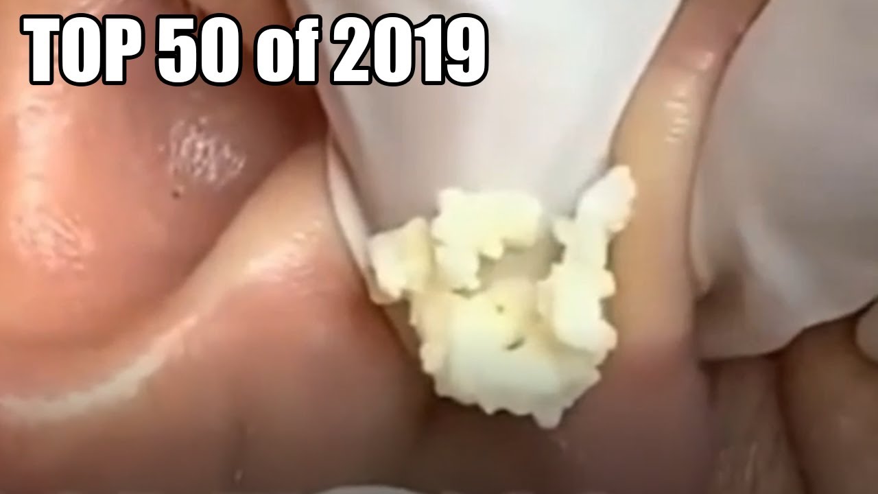 Top 50 Pimple Pops of 2019!  Zits, Acne, Cysts and Blackheads