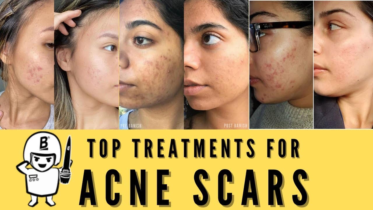 TOP ACNE SCARRING TREATMENTS OF 2021