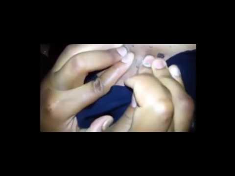Top Blackheads, Pimples And Cysts Extraction .  Pimple Popping   YouTube new