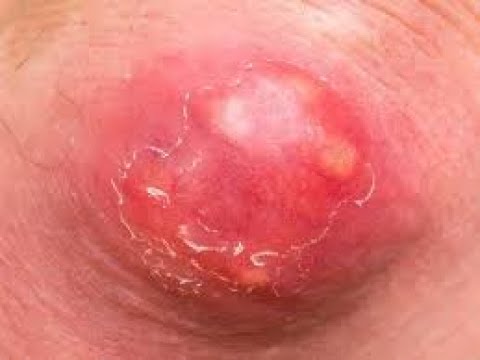 TOP CYST REMOVAL I PIMPLE EXPLOSION