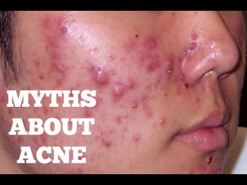 TOP MYTHS ABOUT ACNE