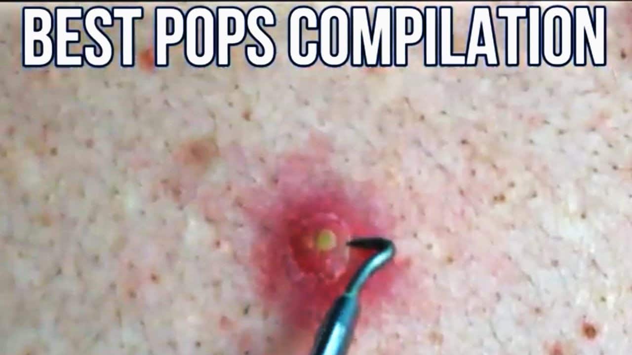 Top Pops! Best Pimple Popping Videos | Popaholic Compilation