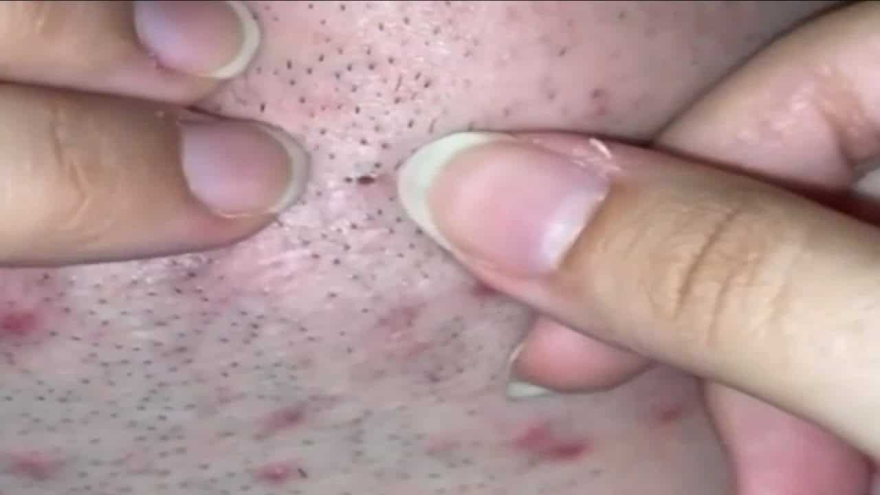 Top Ten Blackheads!  Biggest Blackheads and Pimple Popping