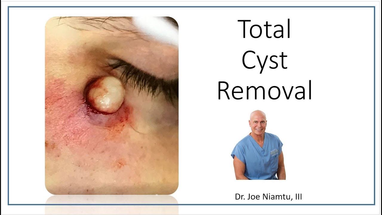 Total Removal of Sebaceous Cyst: The Best Treatment Option