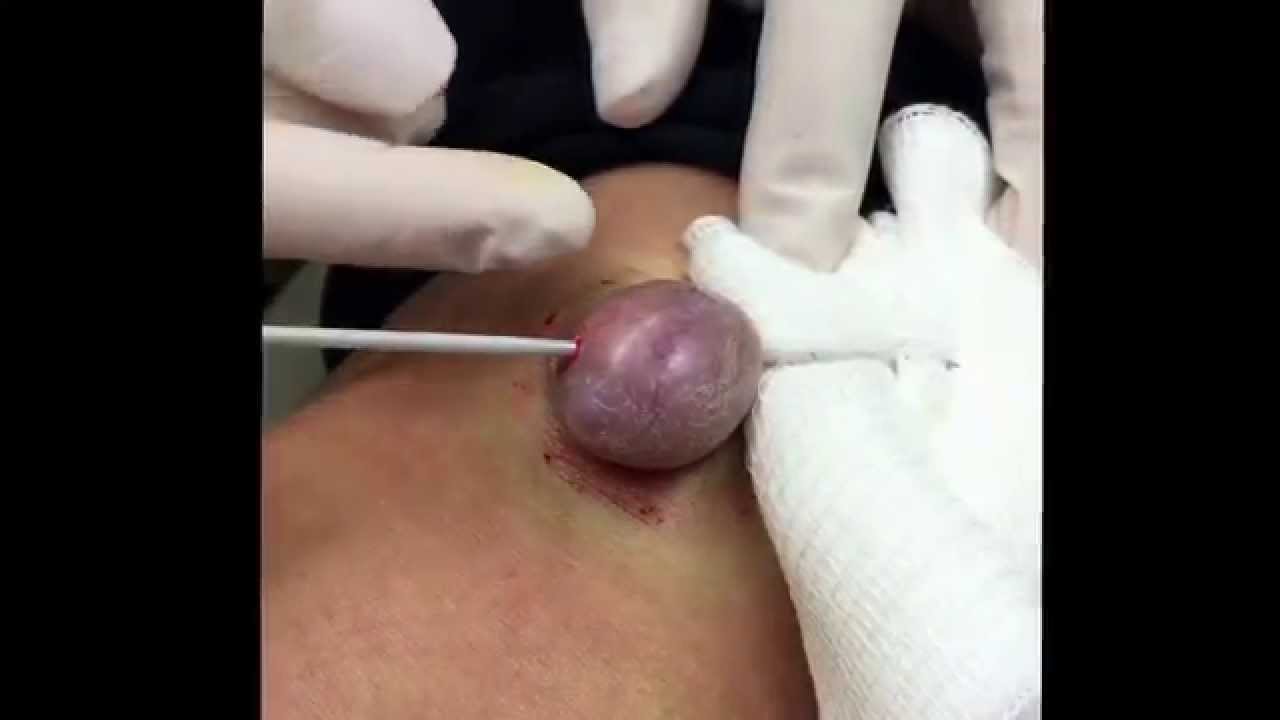 Treating a keloid on the knee with cryoshape. For medical education- NSFE.