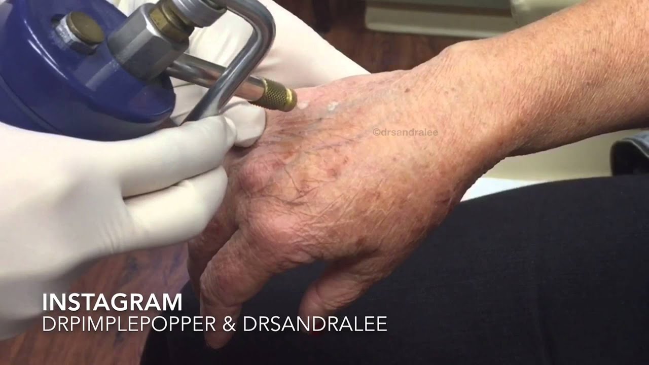 Treating age spots / liver spots on the hands. For medical education- NSFE