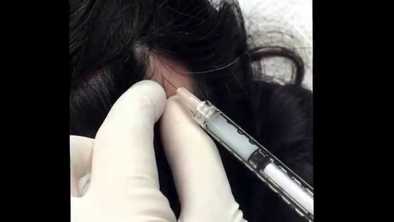 Treating Alopecia areata, a common cause for hair loss. For medical education- NSFE.