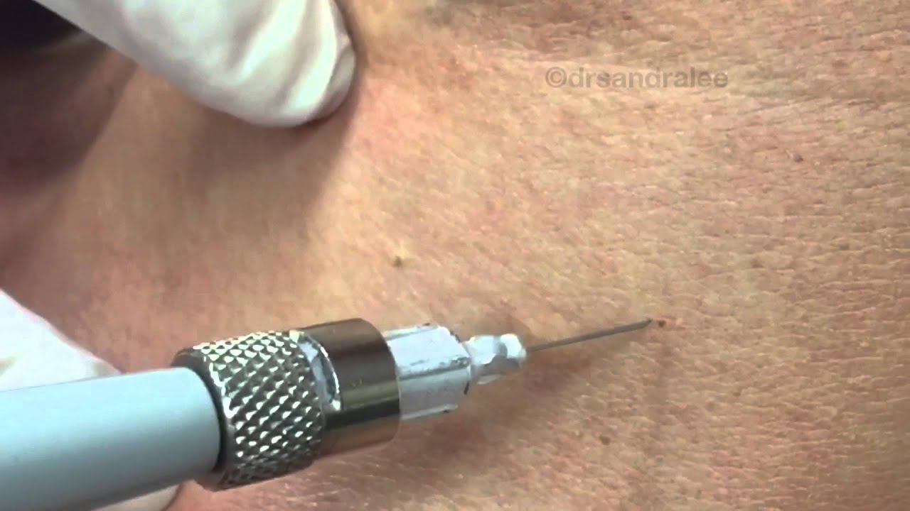 Treating angiomas & DPNs on the chest with electrocautery For medical education- NSFE.