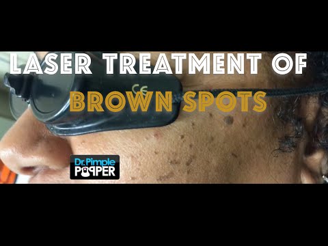 Treating Brown Spots on the Cheeks with a Laser. WARNING strobe-like laser light