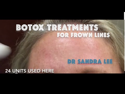 Treating frown lines / glabella area