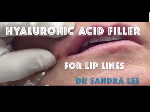 Treating lip lines, and downturned lips with a hyaluronic acid filler