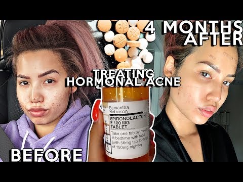 Treating my Hormonal Cystic Acne with Spirolactone | (4 MONTHS) Before & Afters + Pros/Cons