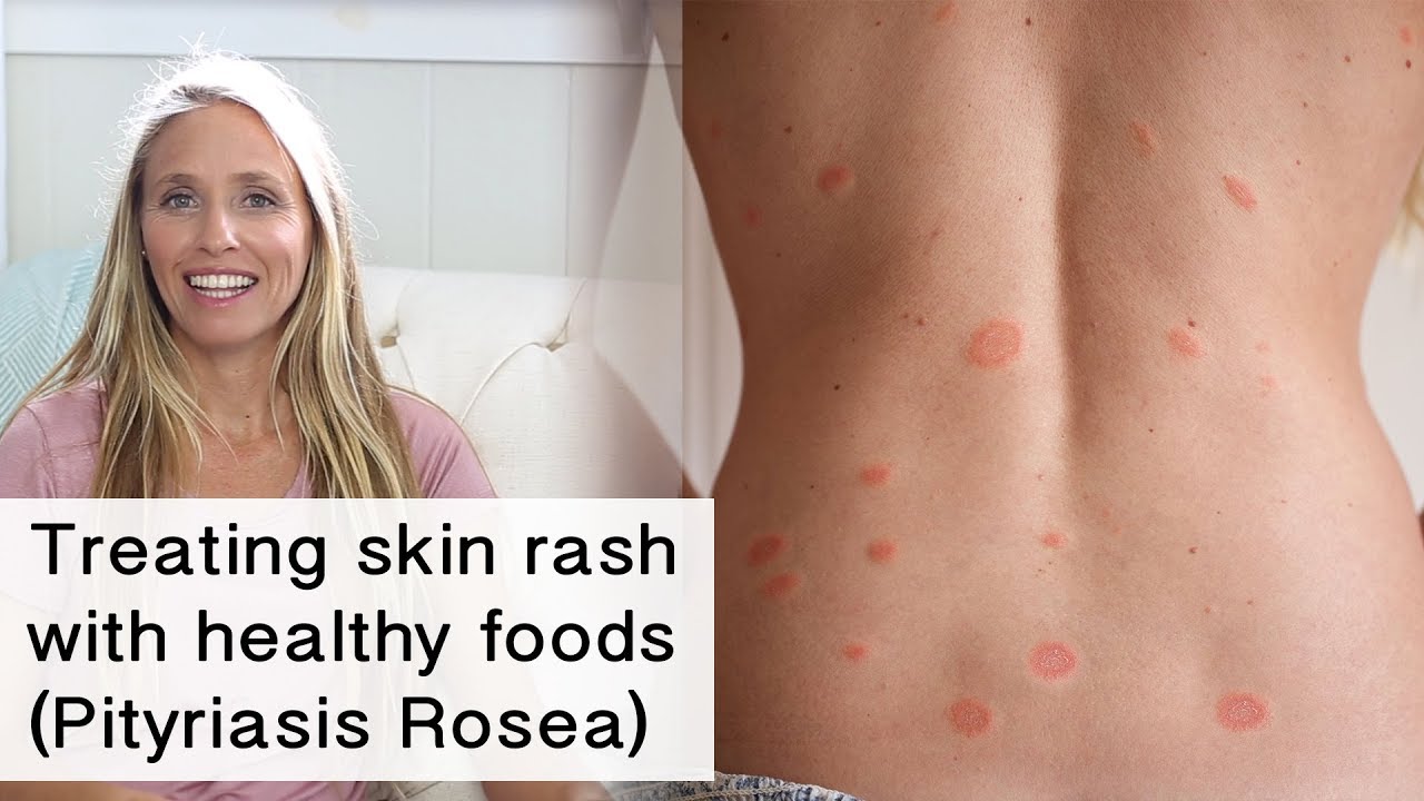 Treating skin rash and inflammation with healthy foods (Pityriasis Rosea)