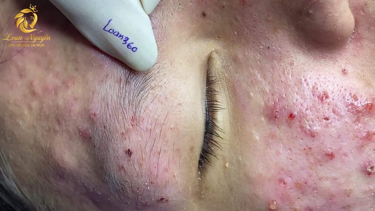 Treatment of acne tablets, pustules and blackheads (360) | Loan Nguyen