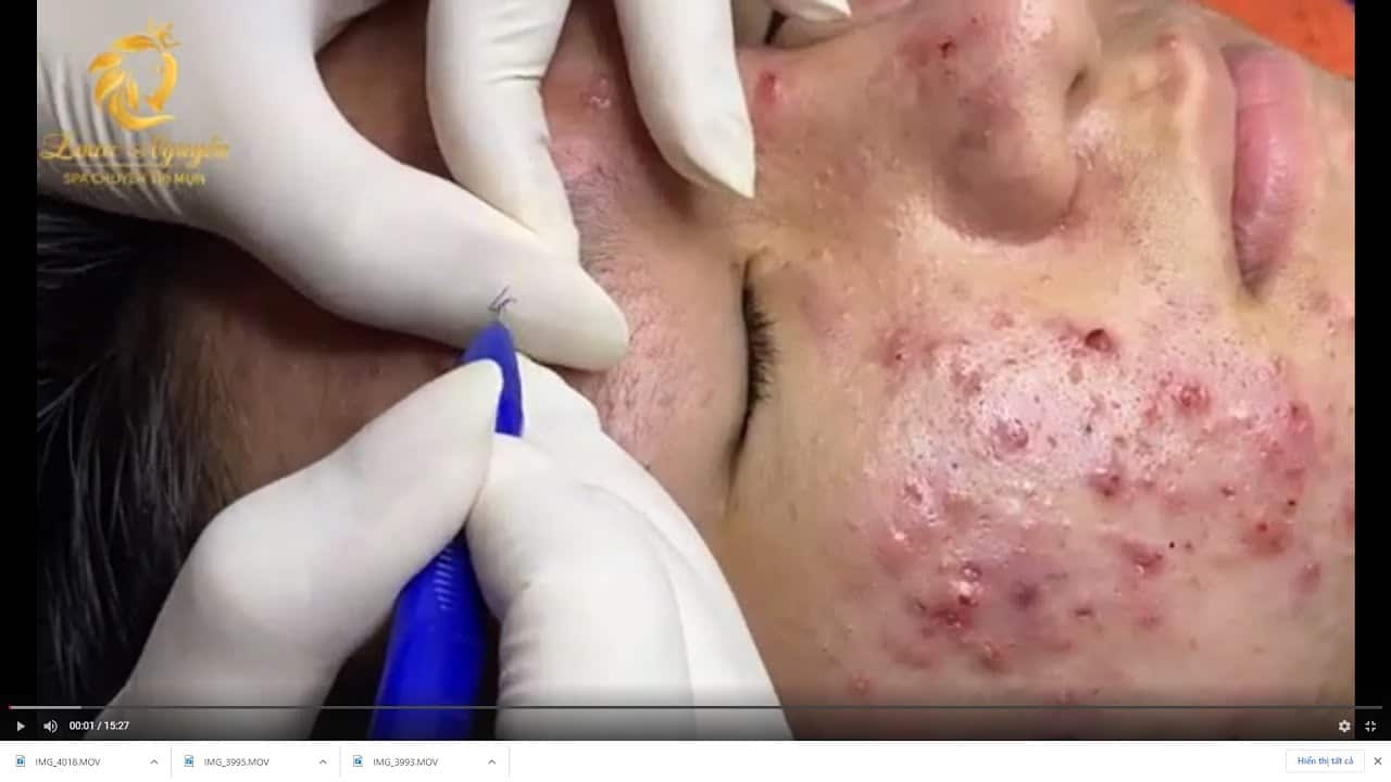 Treatment of acne tablets, pustules and blackheads (359) | Loan Nguyen