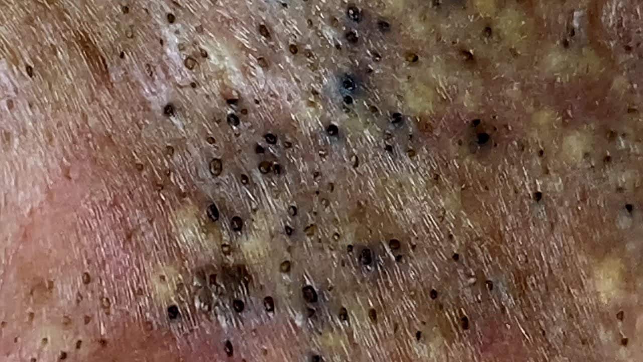 Tons of blackheads on the back. Acne extractions. Blackheads and ...