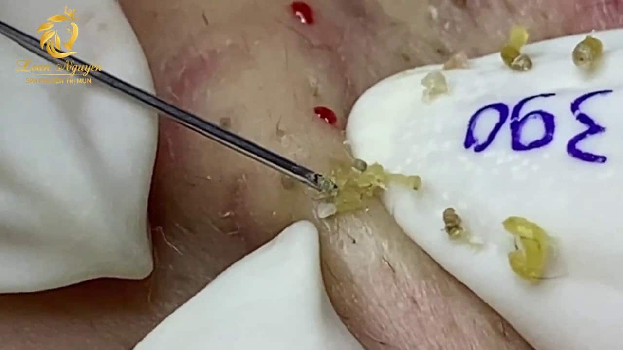 Treatment of blackheads and whiteheads (390) | Loan Nguyen