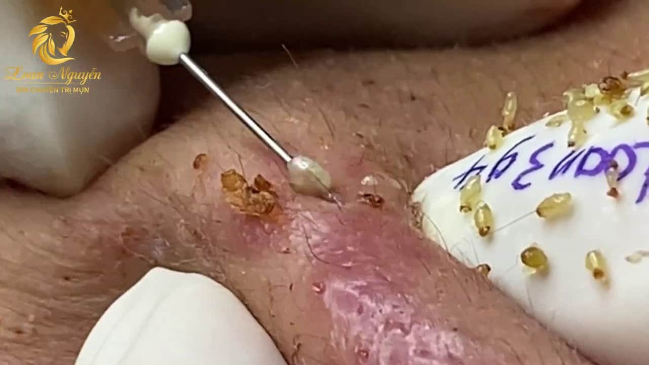Treatment of blackheads and whiteheads (394) | Loan Nguyen
