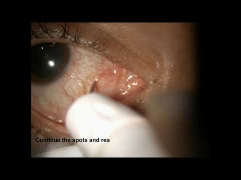 Treatment of Conjunctival Cyst Ablation using ALTP – Supplementary video [ID 265032]