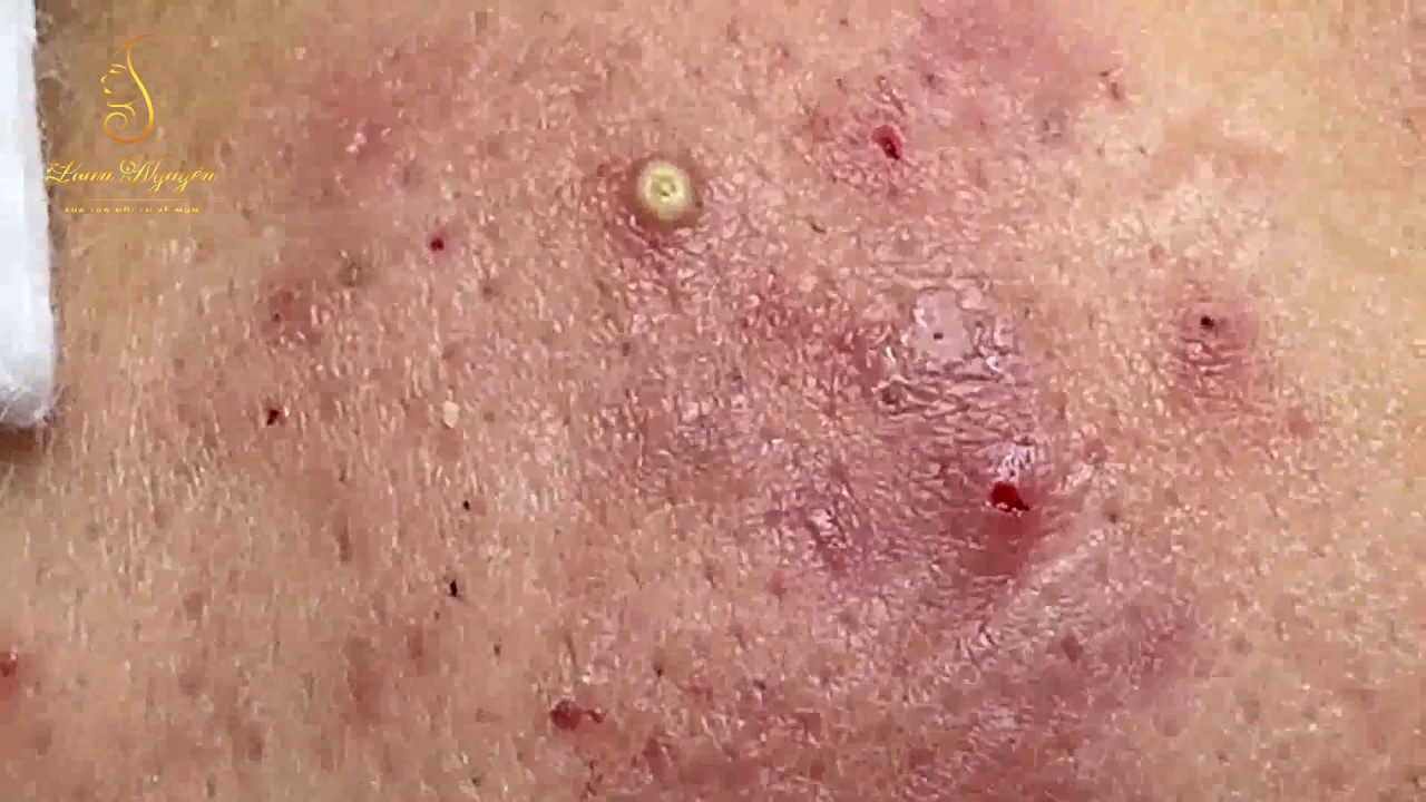 Treatment of pustules and inflammatory acne (84) | Loan Nguyen