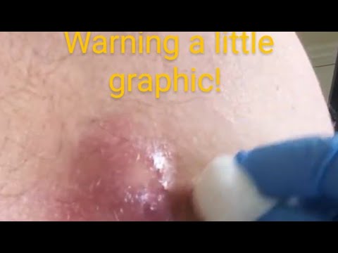 TRYING TO POP MY DAD'S  CYST (WARNING LIL GRAPHIC)