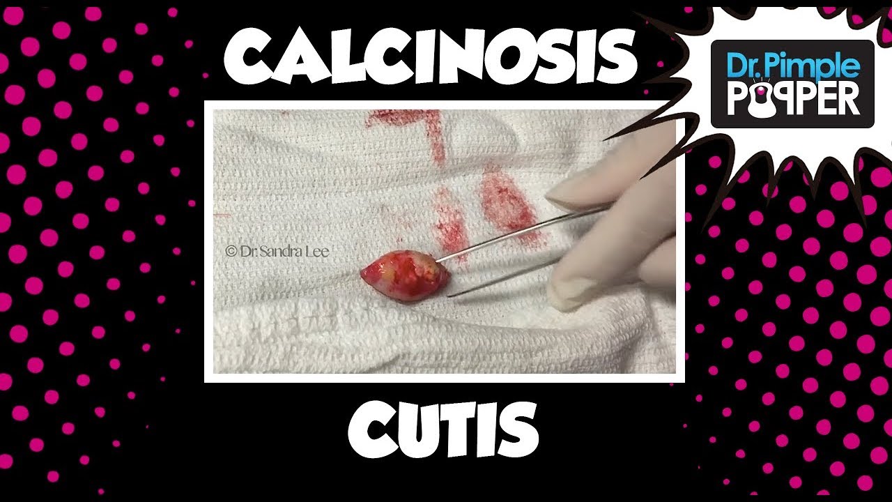 Two “Cysts” Calcinosis Cutis