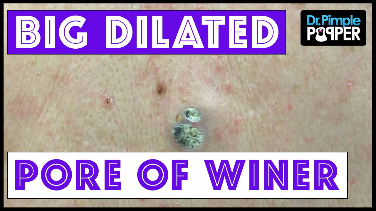Two HUGE Dilated Pores of Winer!!