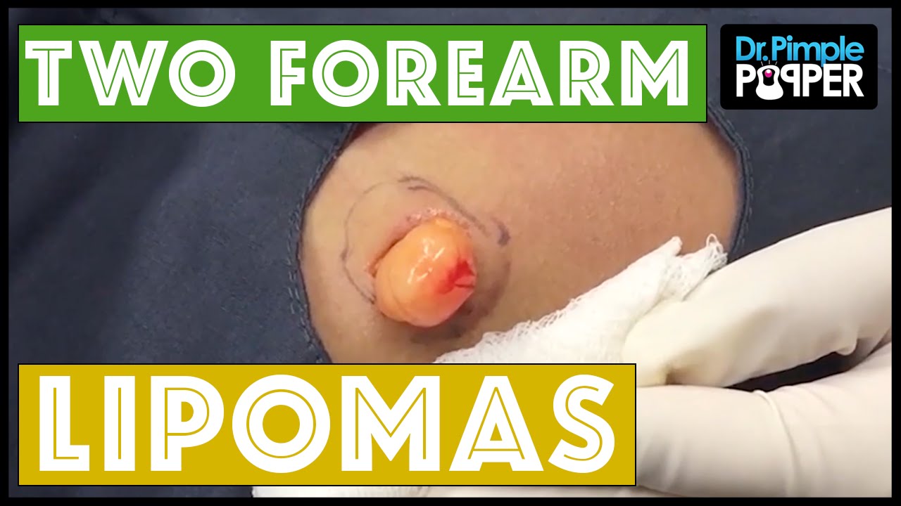 Two Lipomas! Popped from the Arm with Dr. Pimple Popper