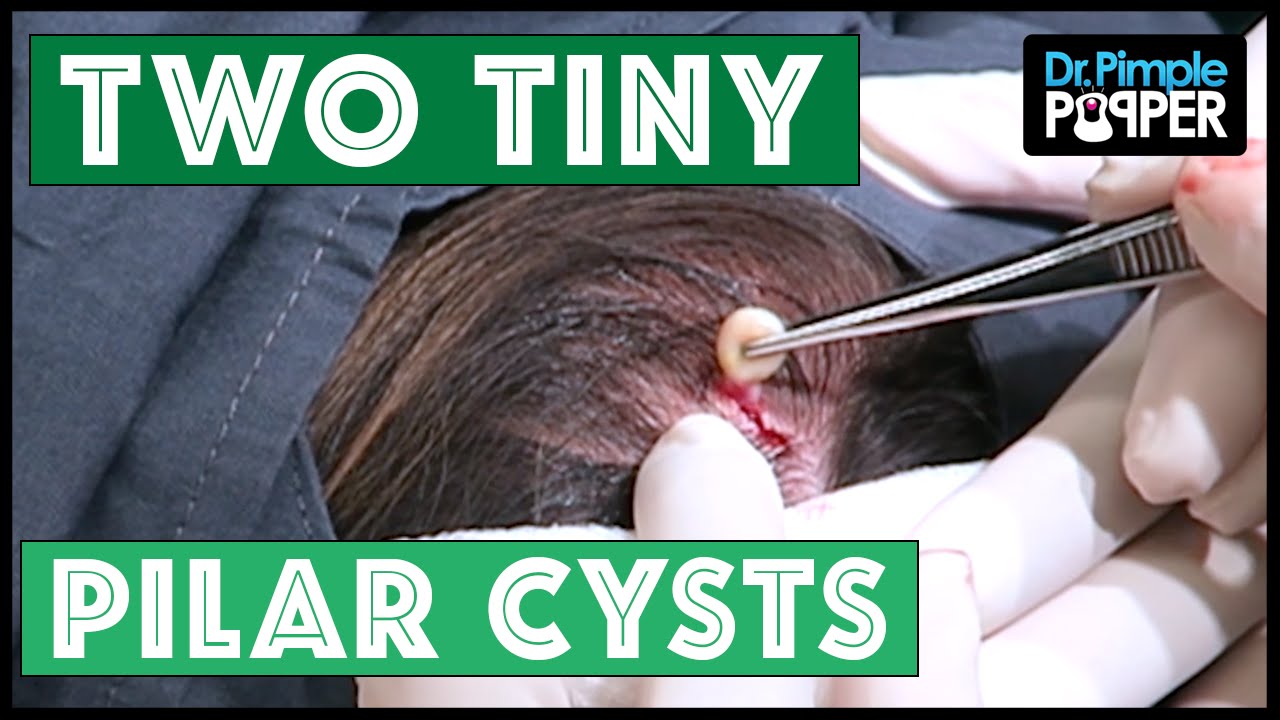 Two Mighty Pilar Cysts!