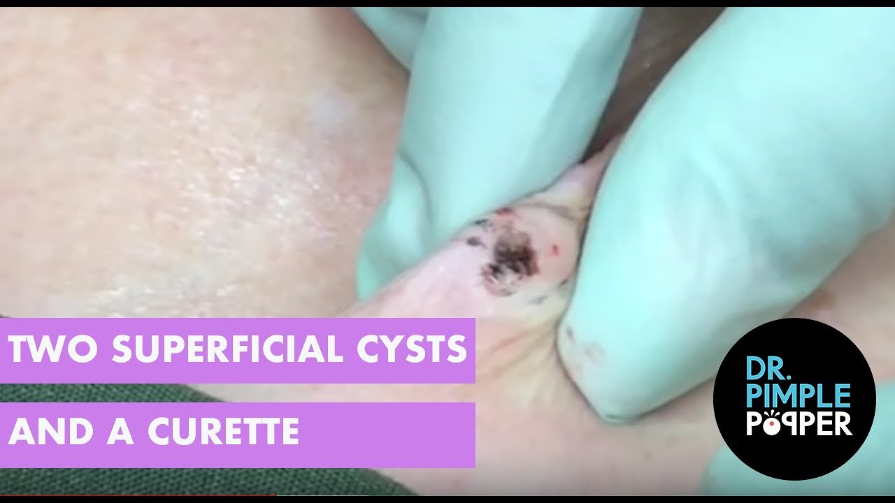 Two Superficial Cysts and a Curette