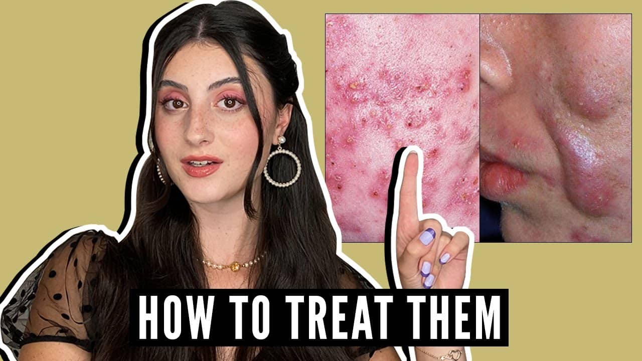 Types of ACNE and How to Treat Them