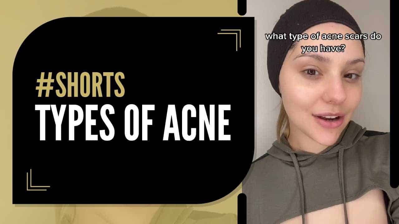 Types of Acne Pt 2