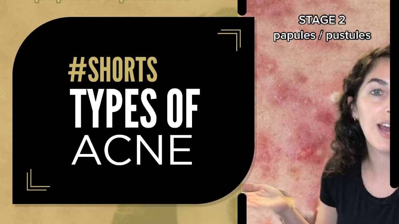 Types of Acne | WHAT IS YOUR TYPE?