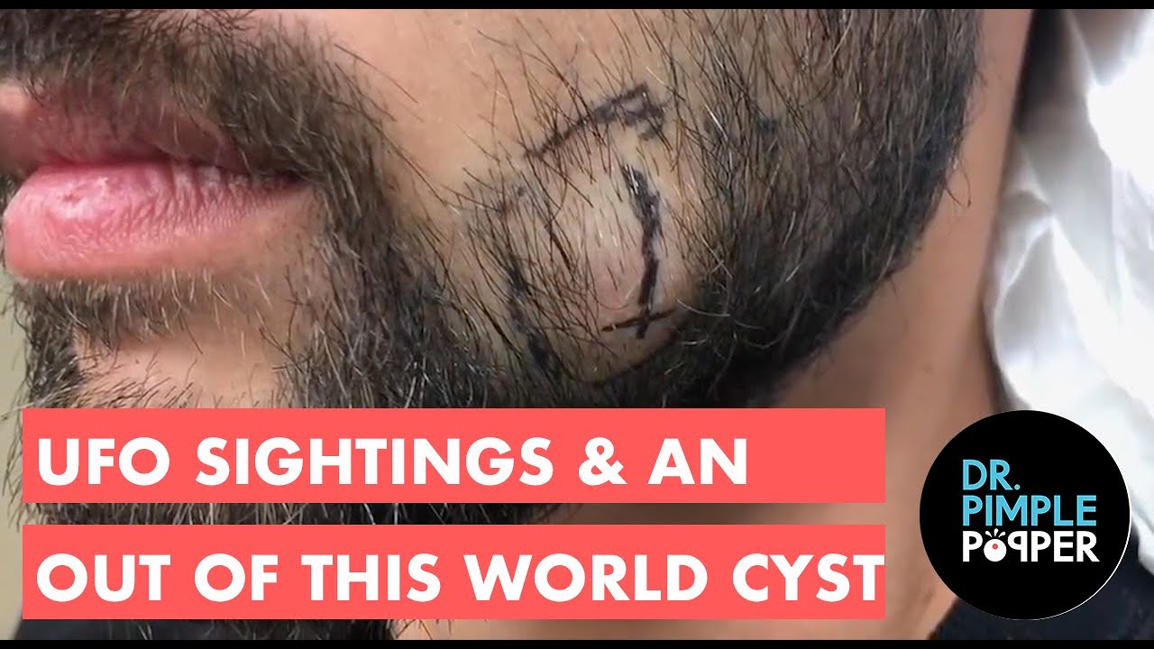UFO Sightings & An Out of This World Cyst