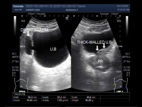 Ultrasound Video showing Vesical Diverticulum, Cystitis, BPH, Cholelithiasis, and small renal stone.