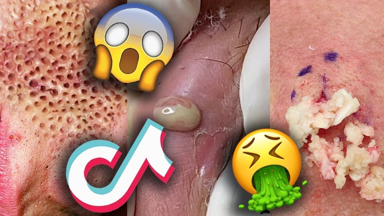 Under skin pimple popping #cystpopping #fypシ #pimple #acne #blackhead #foryou #fyp