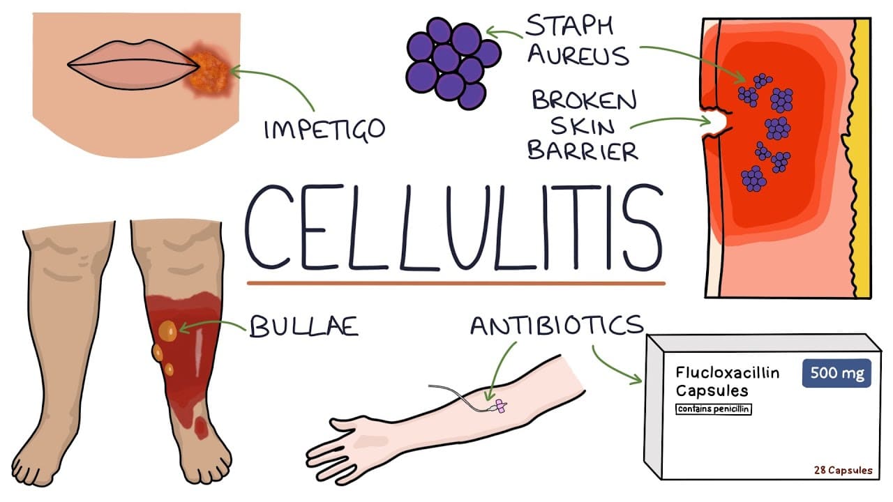 Understanding Cellulitis: Skin and Soft Tissue Infections