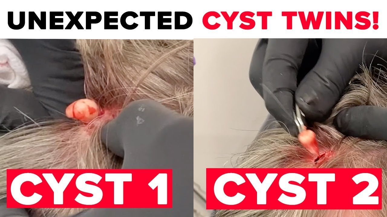 UNEXPECTED CYST TWINS!