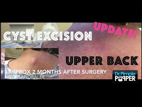 Update: Two months after cyst removal on the upper back