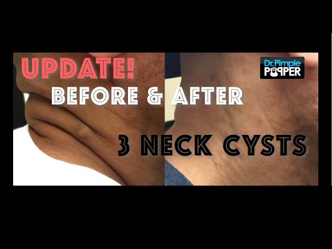 Update with Before and After photos, epidermoid cysts removed on neck