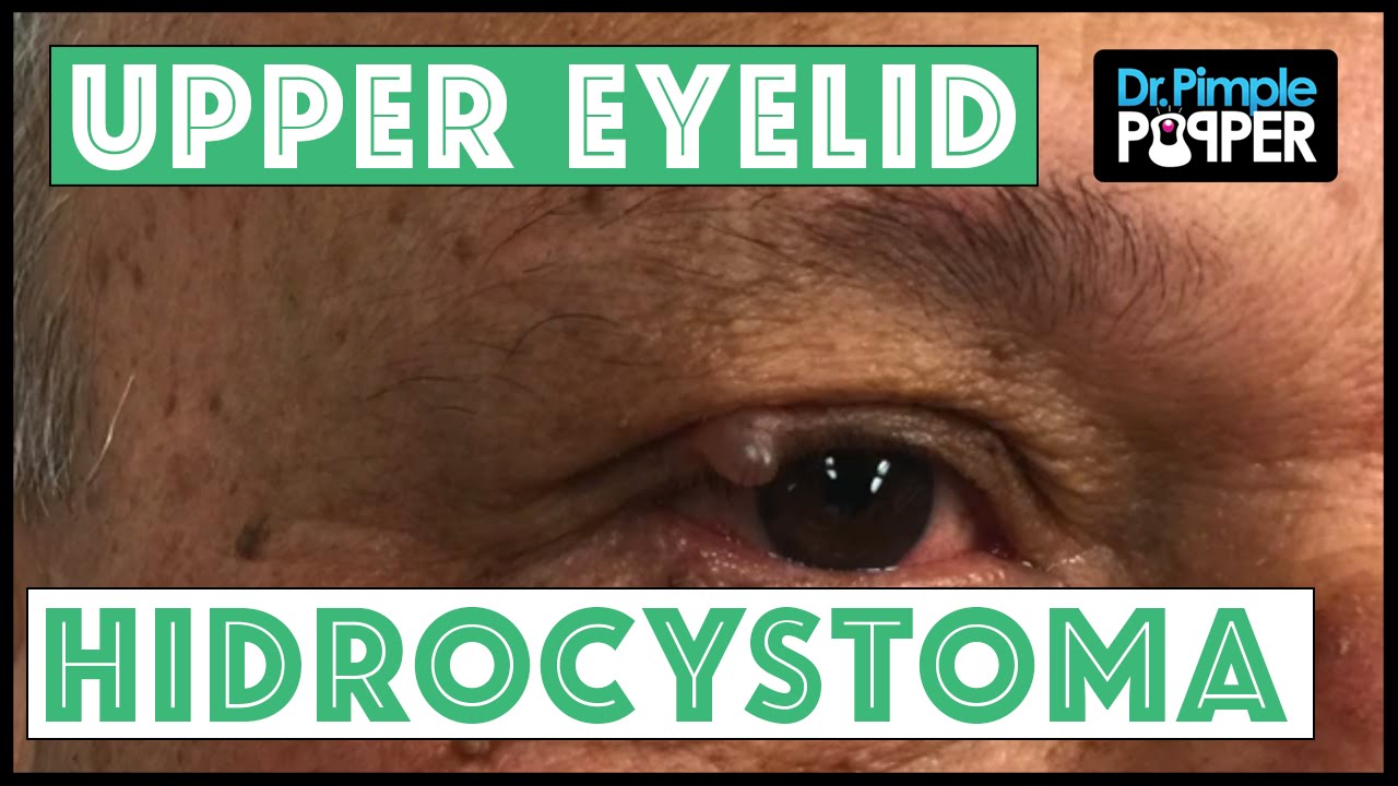 Upper Eyelid Hidrocystoma