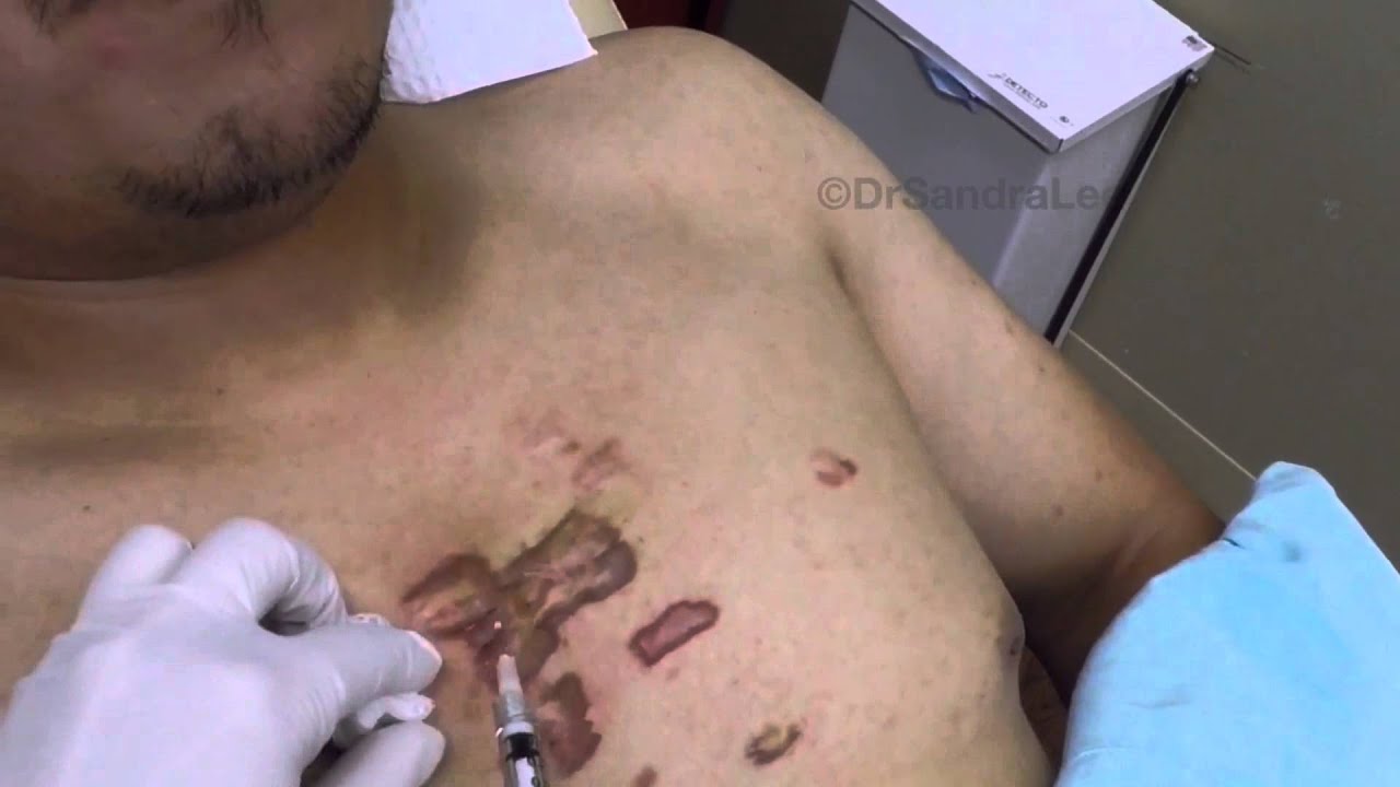 Using my Gopro: Treating keloids with IL steroids and Vbeam For medical education- NSFE.