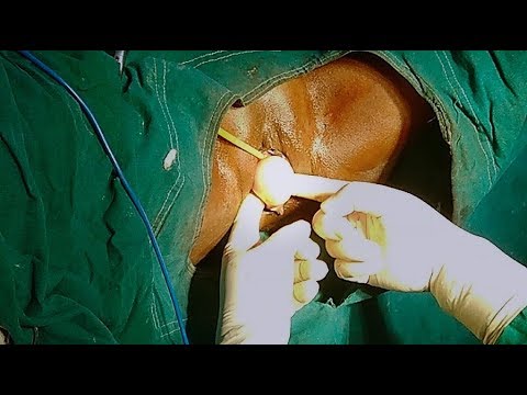 Vaginal Cyst Excision by Dr.Avijit Basak