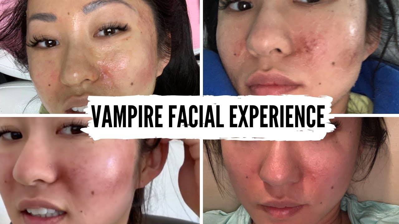 VAMPIRE FACIAL: I TRIED MICRONEEDLING WITH PRP. BETTER THAN AT HOME MICRONEEDLING?