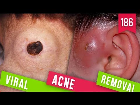 VIRAL ACNE REMOVAL | VIRAL BEAUTY | PIMPLE POPPING
