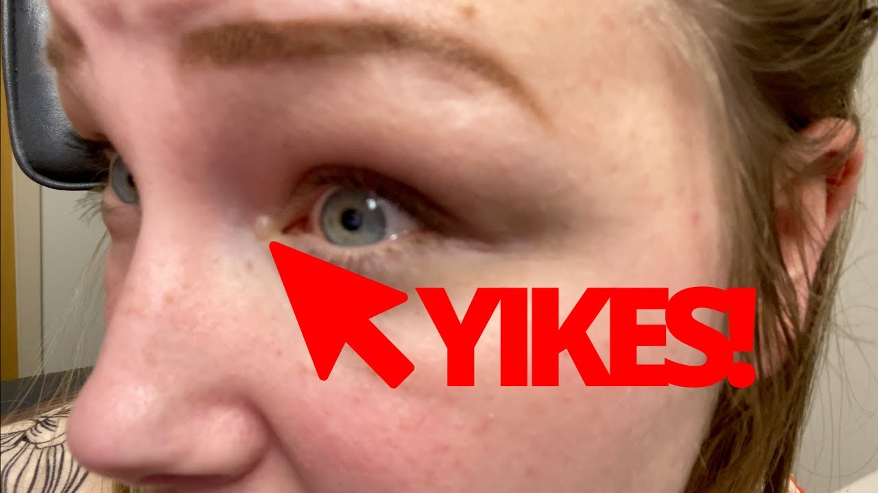 VLOG: 2ND ATTEMPT AT POPPING EYE CYST! | At Home With Tia