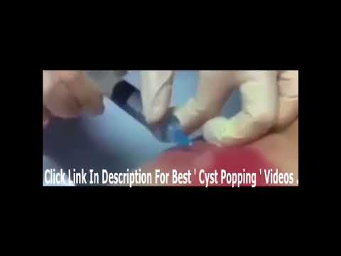 WARNING Disgusting Cyst Popping Compilation