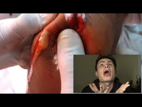 WARNING! GROSSEST PIMPLE POPPING BROKEN NOSE COMPILATION TRY NOT TO LOOK AWAY!!!
