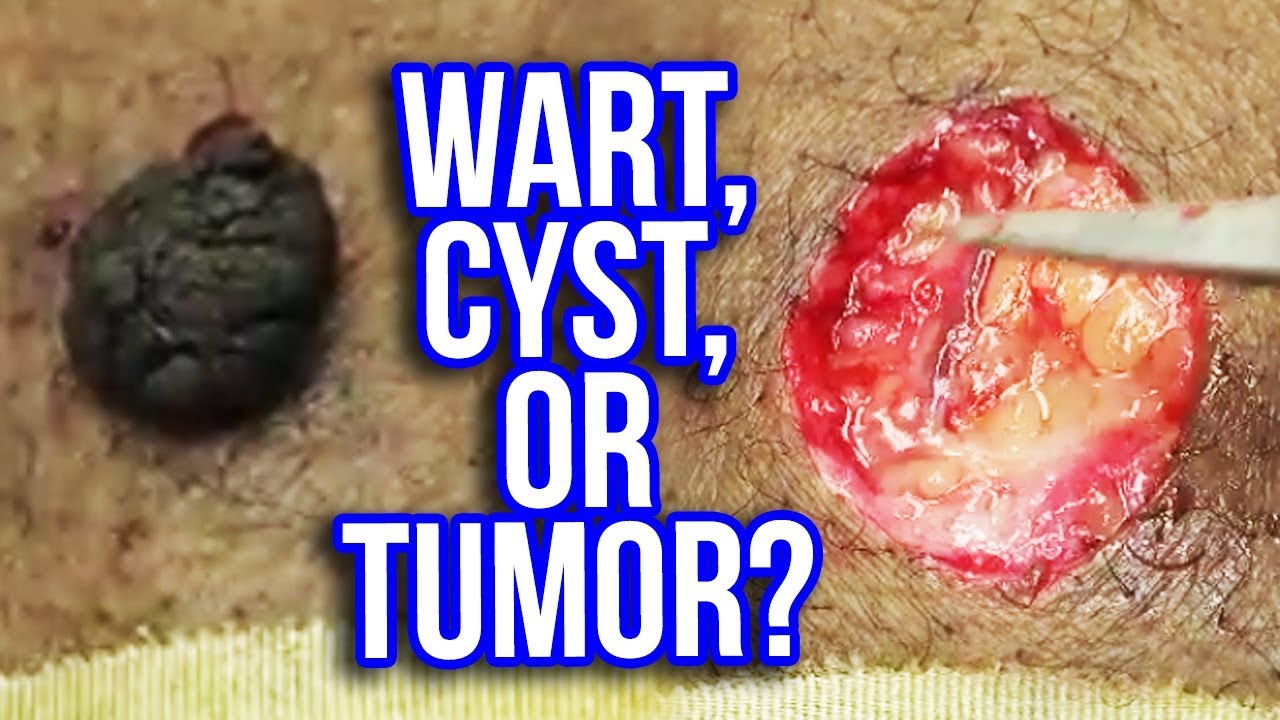Wart, Growth, Cyst or Large Neoplasm?  What is it?
