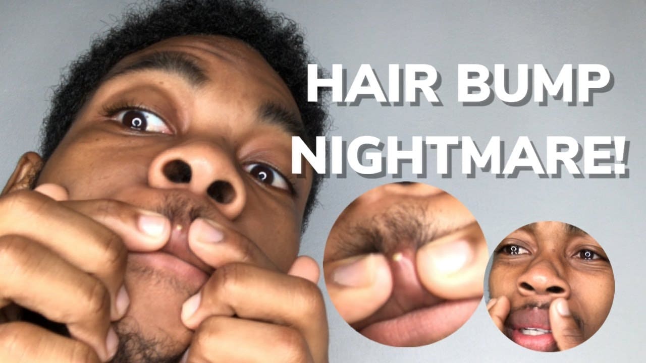 WATCH ME FIGHT A TOUGH HAIR BUMP (PIMPLE POPPING)